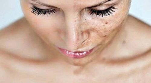 Chemical-peel GoldenOrchard