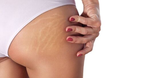 StretchMarks-copy GoldenOrchard