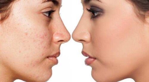 keep-acne-at-bay (2) GoldenOrchard